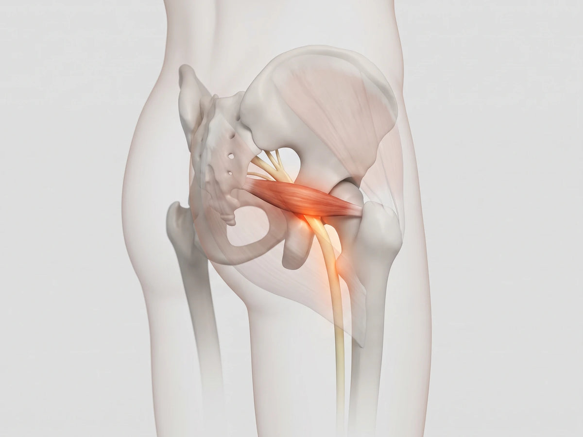 Vu de dos, le bassin en transparence : un petit muscle profond, au fond de la fesse, crispé, serre le nerf qui descend dans la jambe
