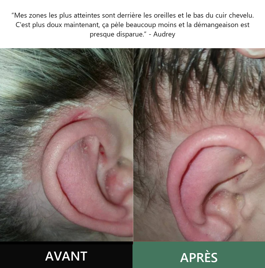Avant / après — témoignage Audrey